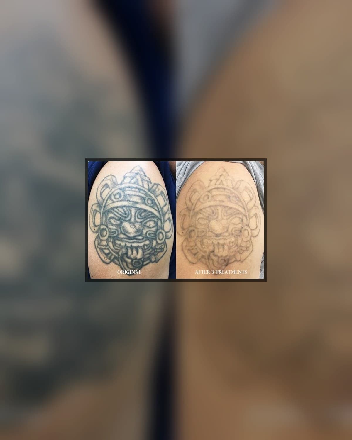 Cover-Up Tattoos Austin TX: When Laser Helps