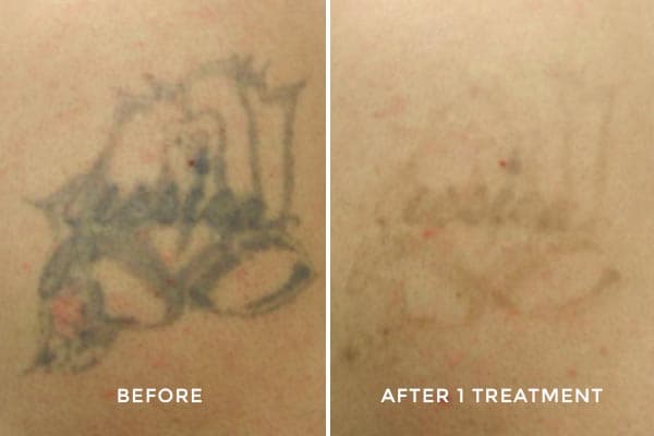 Laser removal progress — full back piece