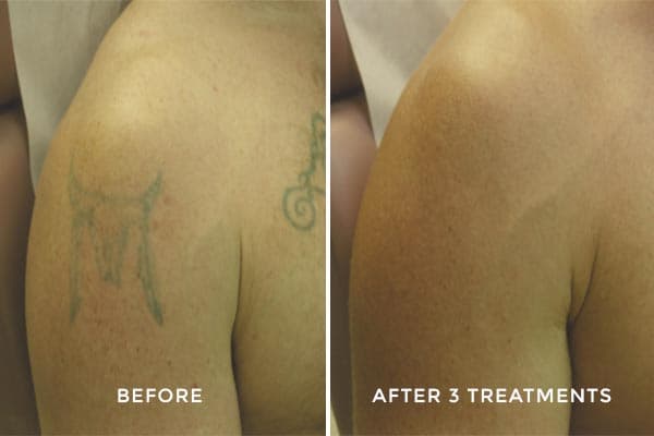 Laser removal before and after — cow skull tattoo