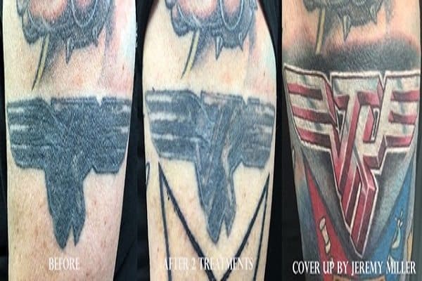 Laser removal before and after — wrist tattoo