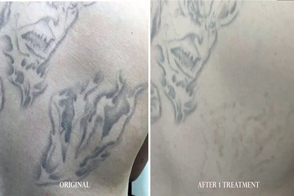 Laser removal before and after — forearm tattoo