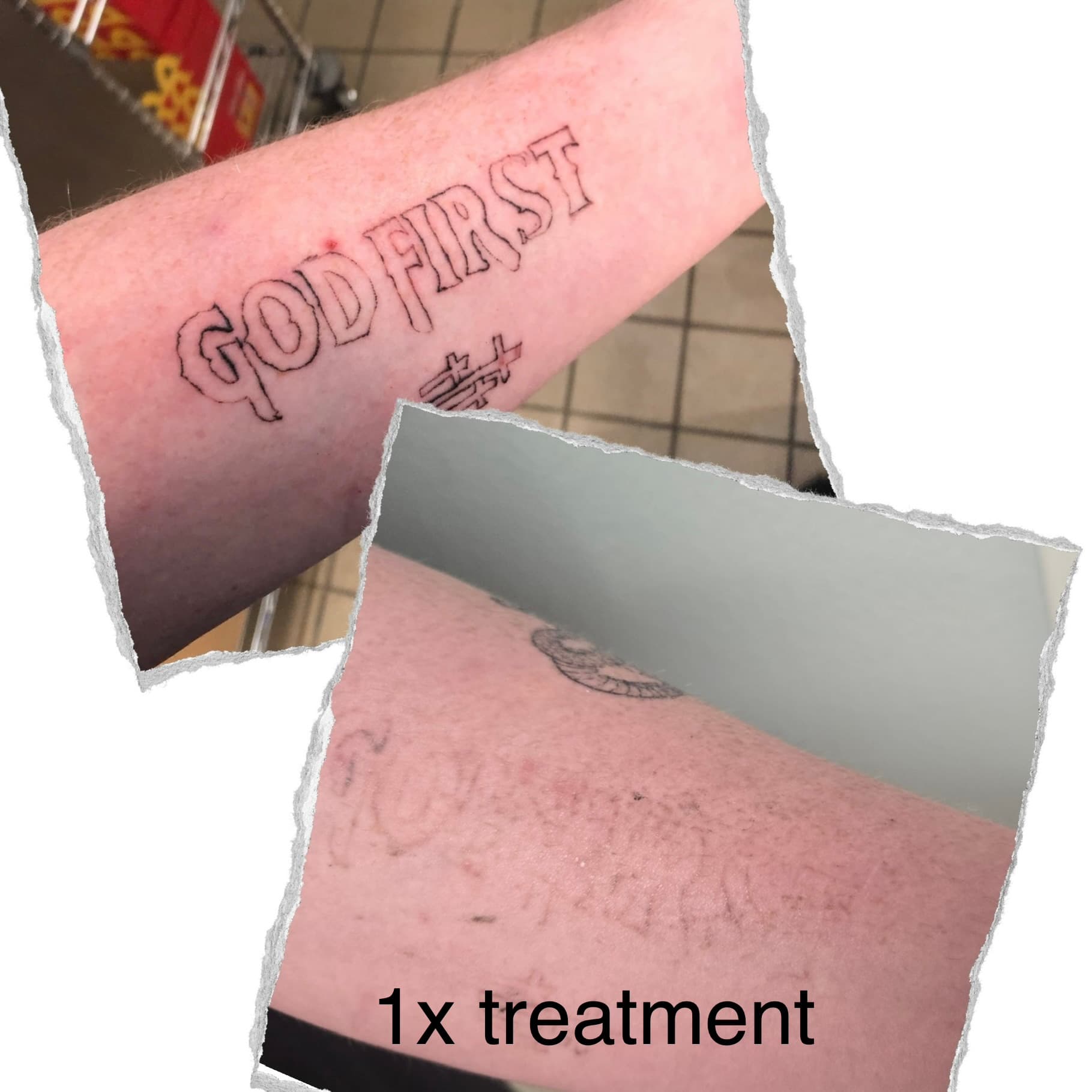 Laser tattoo removal progress — session 1
