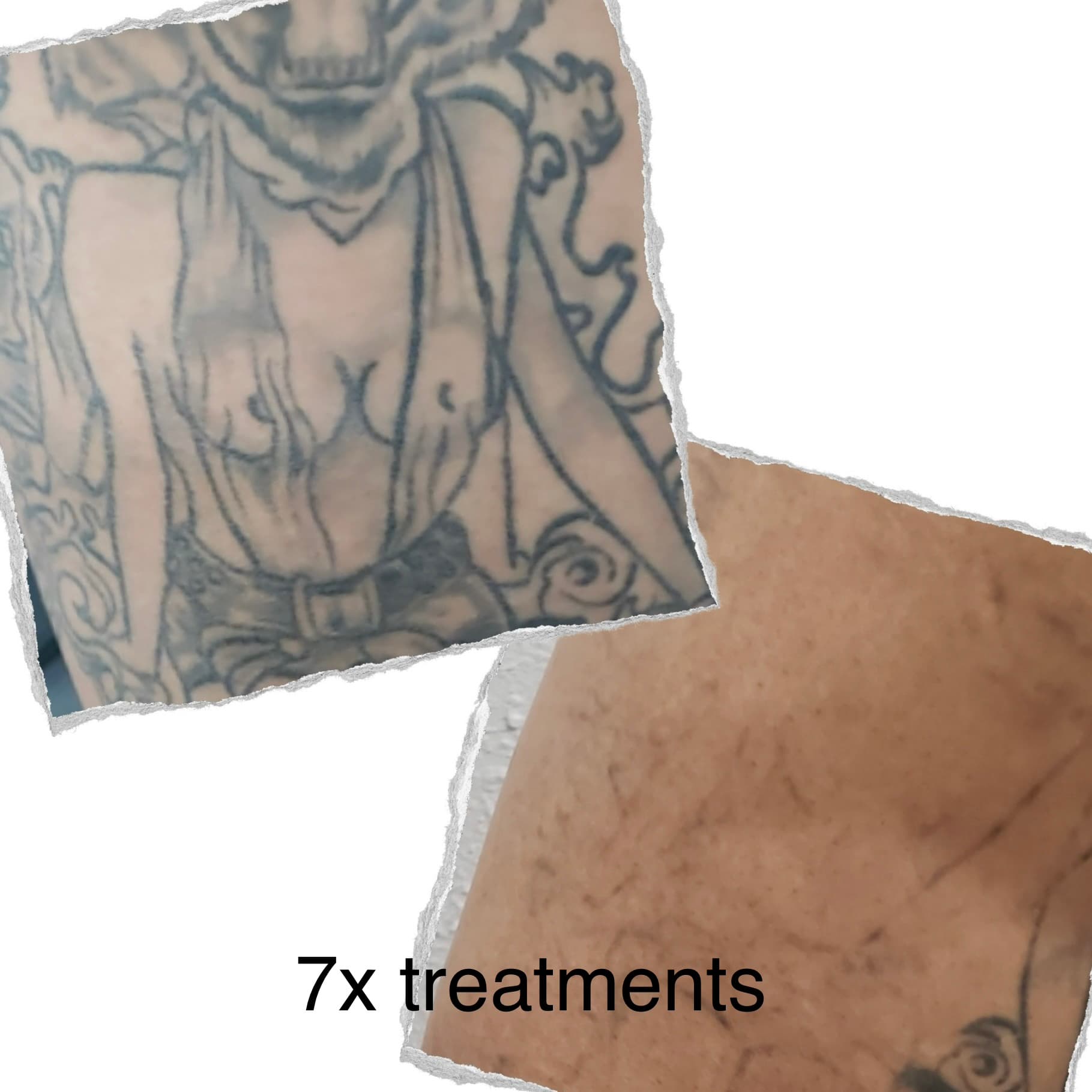 Laser tattoo removal progress — session 2