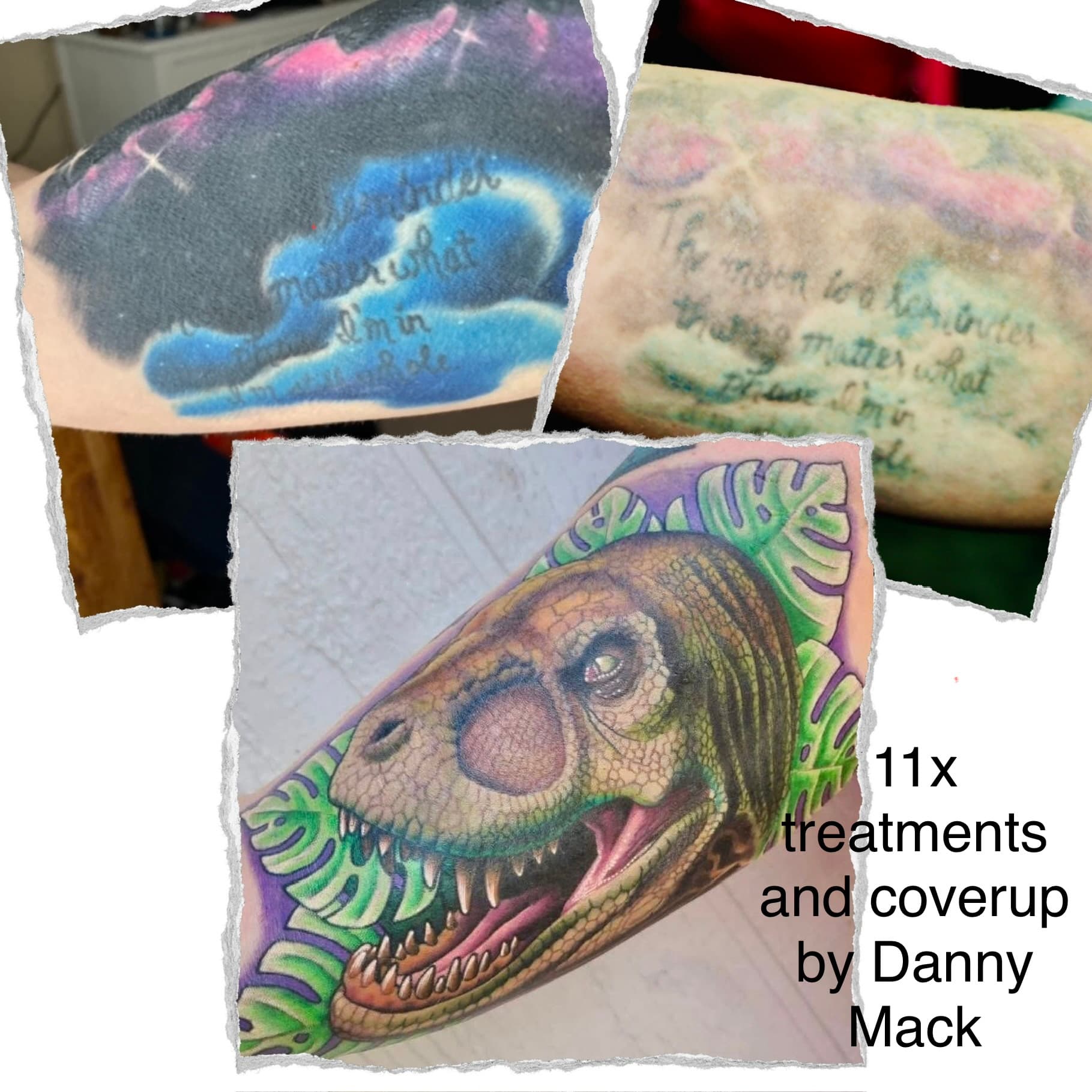Laser tattoo removal progress — session 3