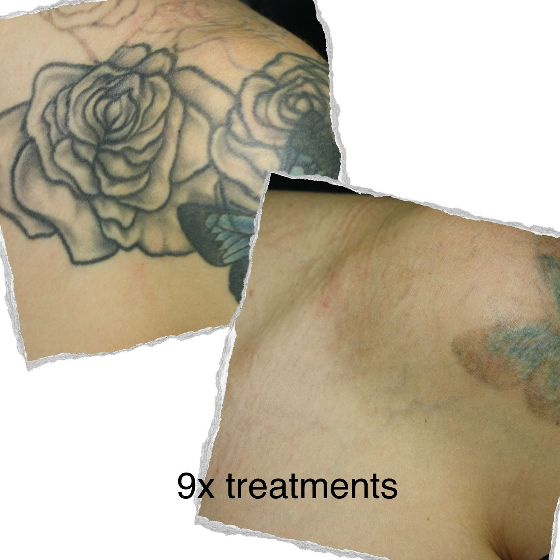 Laser tattoo removal progress — session 4