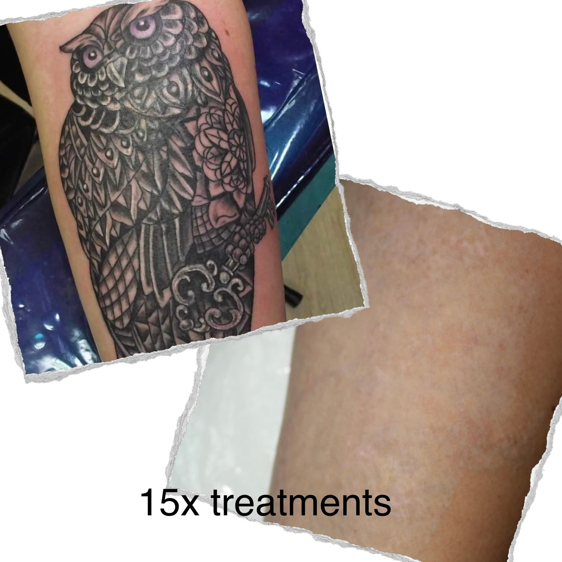 Laser tattoo removal progress — session 5