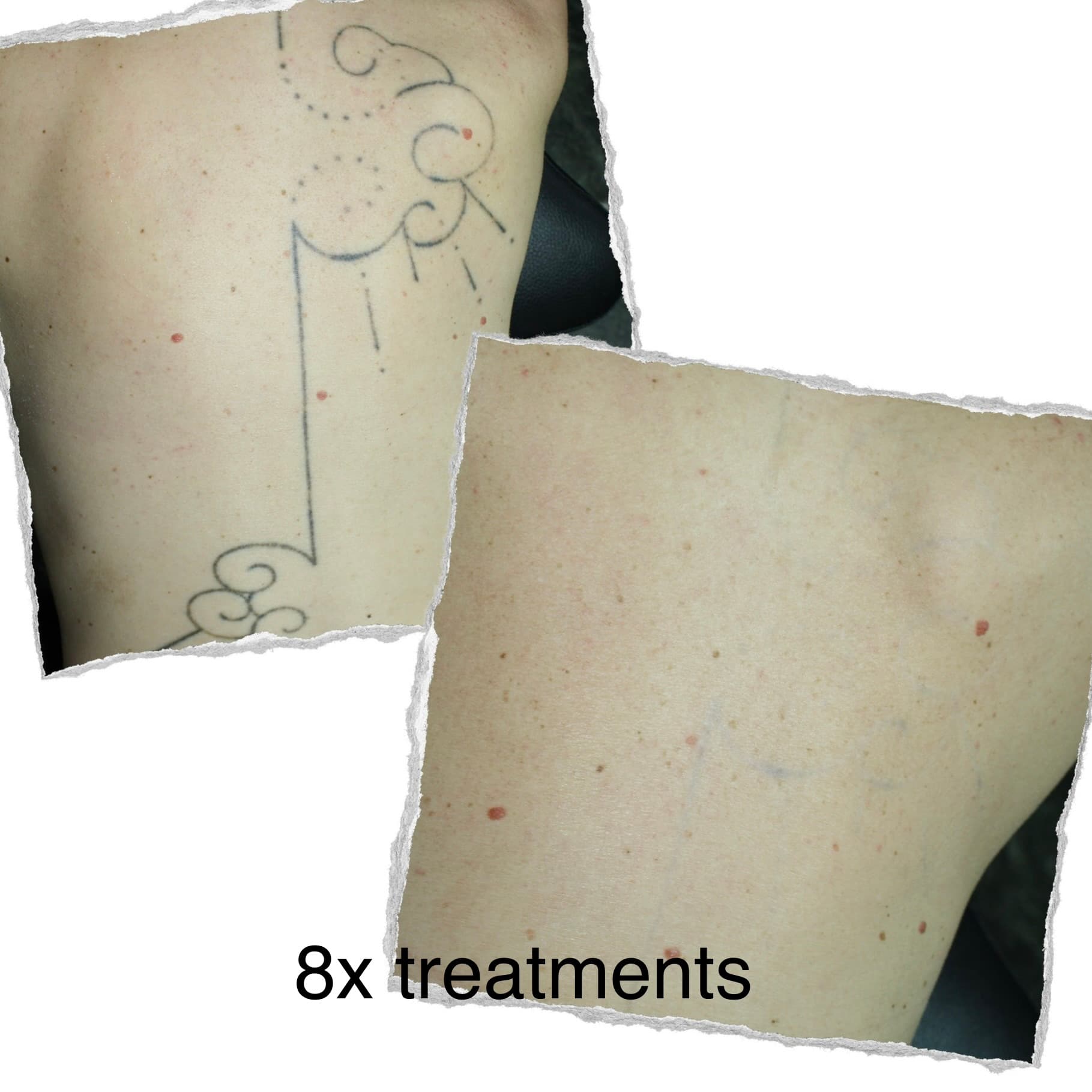 Laser tattoo removal progress — session 6