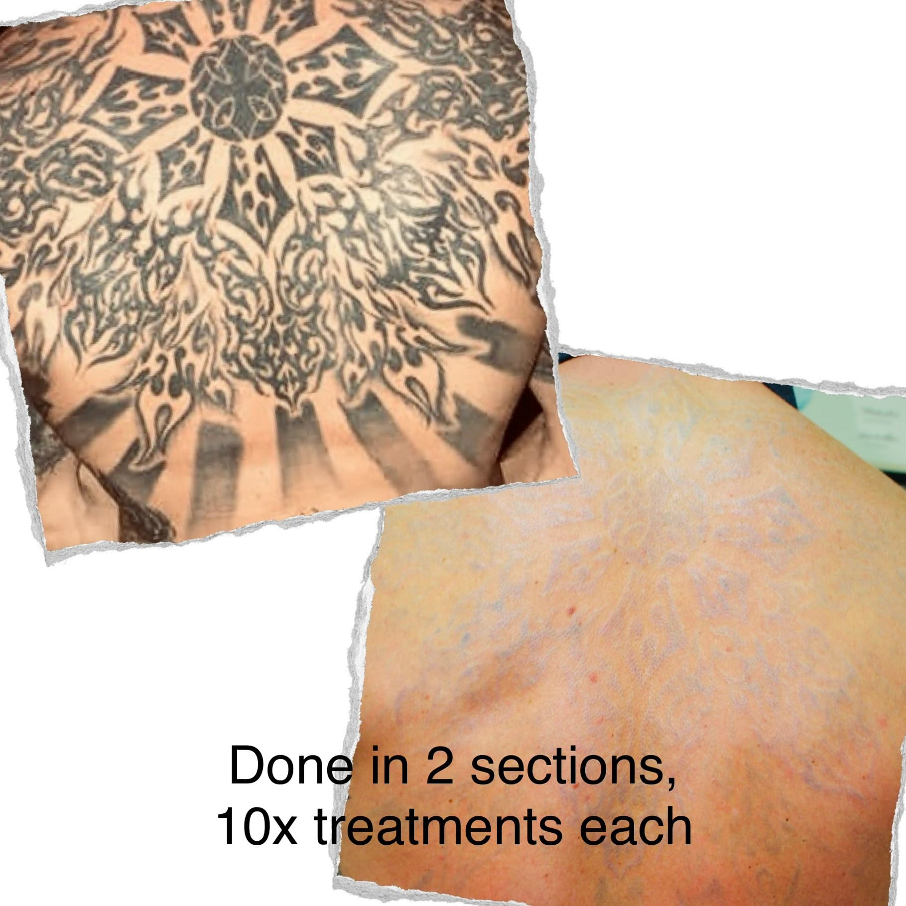 Laser tattoo removal progress — session 7