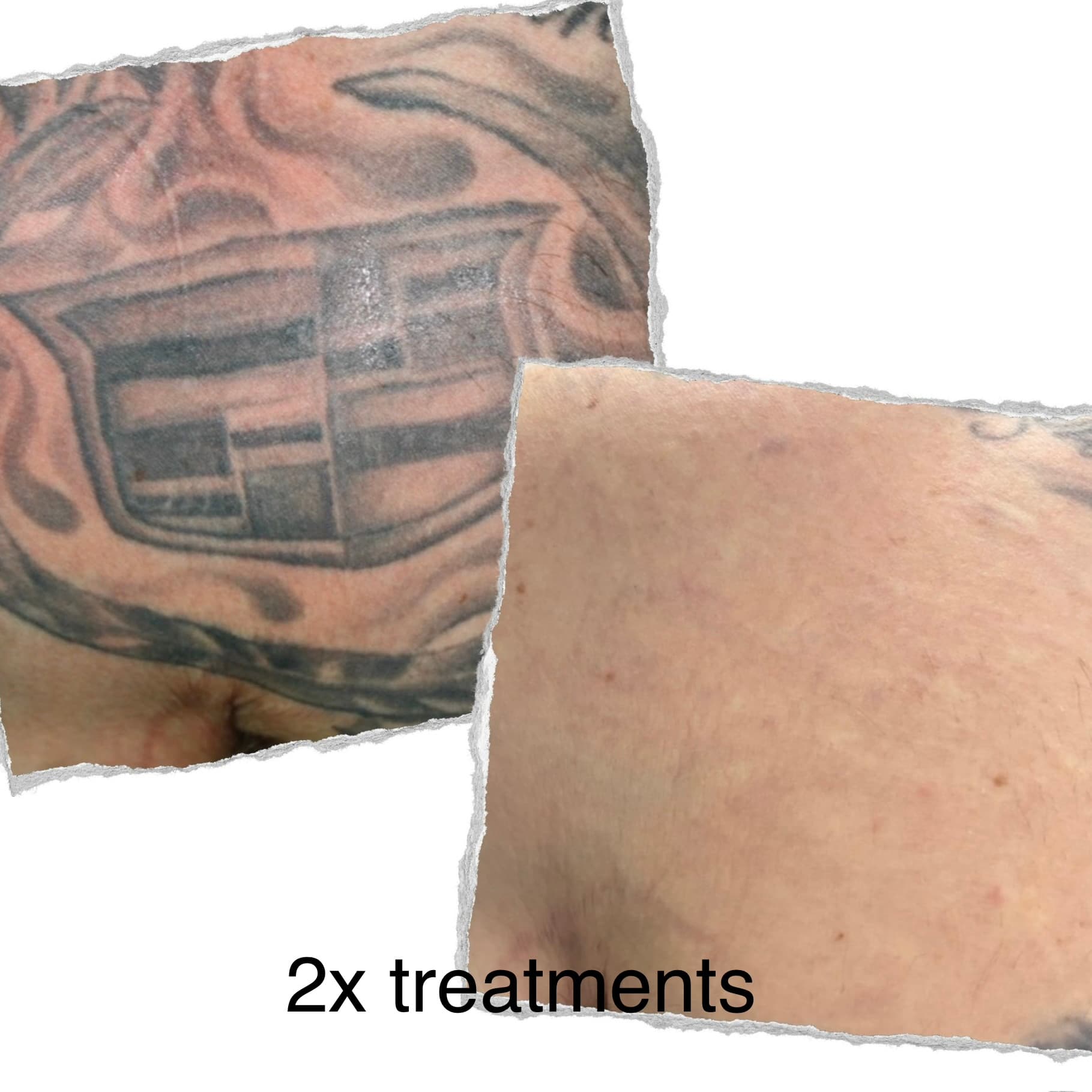 Laser tattoo removal progress — session 8