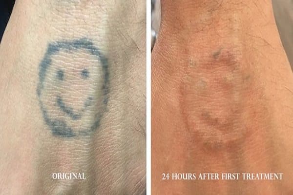 Laser Tattoo Removal Before A Cover-Up: How Austin Clients Should Decide